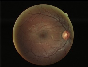 Fotografia de fundo de olho normal, clique aqui paa ver detalhes sobre a retina