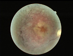 Fundo de olho afectado por Retinitis Pigmentosa Tipica