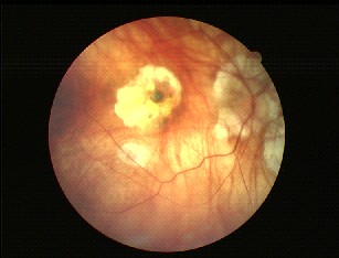Fundo de olho afectado por uma Distrofia de Corides